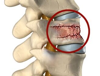 A dor nas costas pode ser causada por enfermidades da columna vertebral e dos discos intervertebrais. 