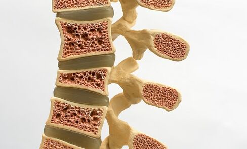 A osteoporose é unha das causas da dor lumbar