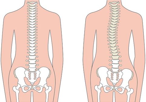 Dor lumbar debido a unha deformidade da columna vertebral como a escoliose