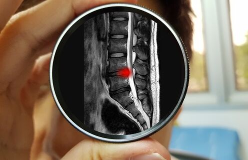 O resultado de ignorar a dor lumbar pode ser unha hernia de disco. 