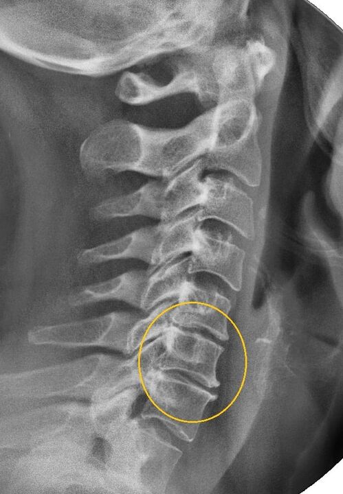 Osteocondrose cervical na radiografía