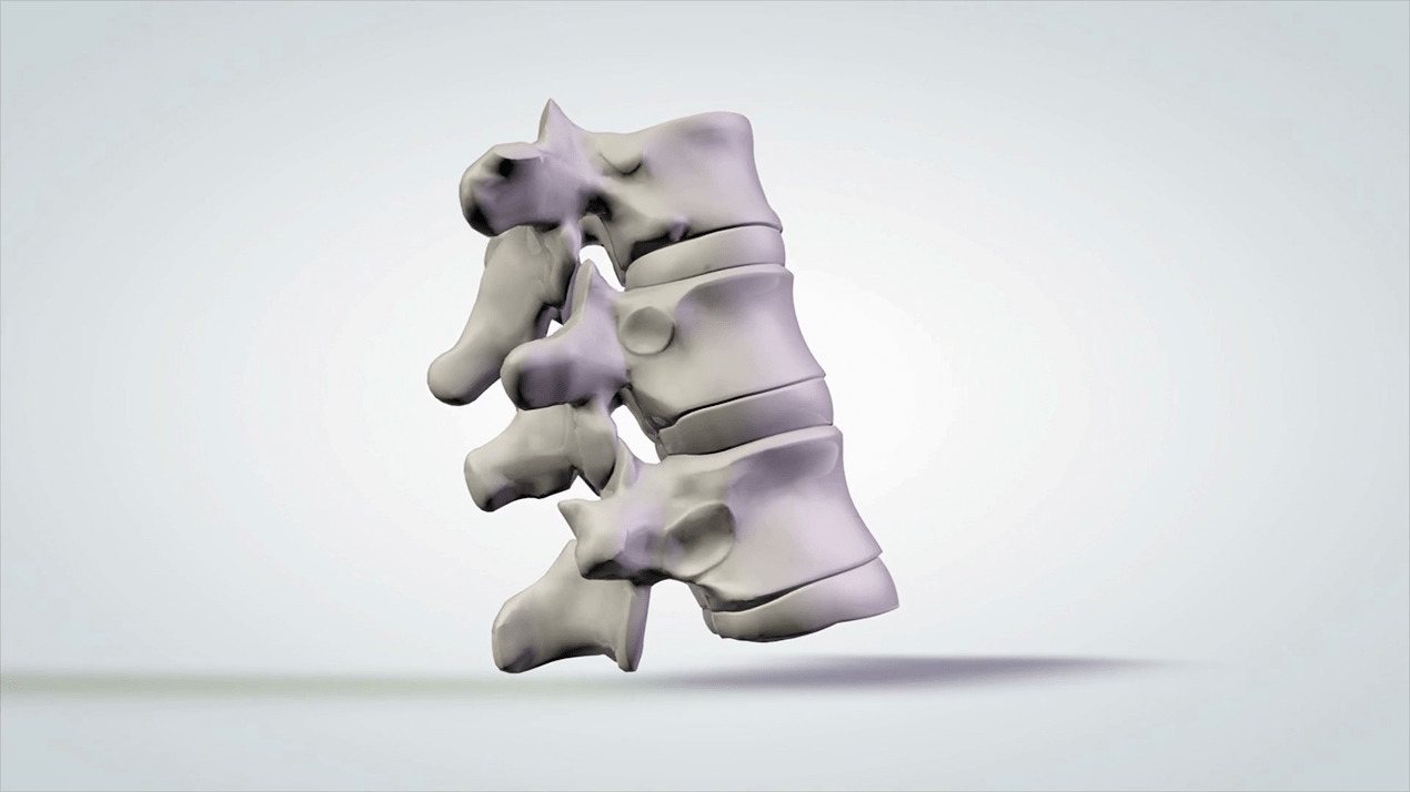 Dano á columna vertebral causado pola osteocondrose cervical