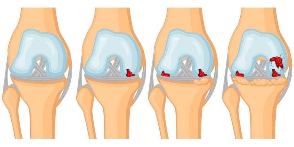 Grao de desenvolvemento da artrose articular