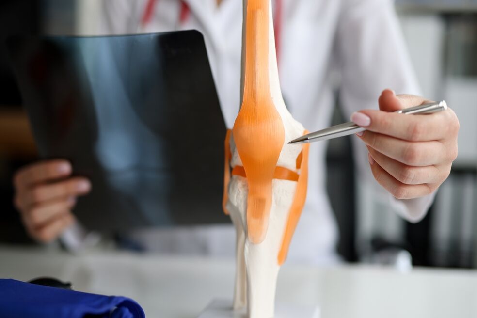 Representación dunha articulación na que os cambios dexenerativos conducen ao desenvolvemento da artrose