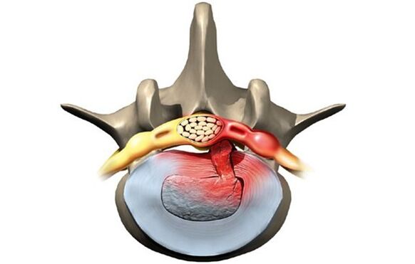 Vértebra afectada por osteocondrose
