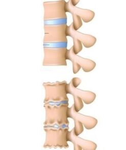 Causas da osteocondrose